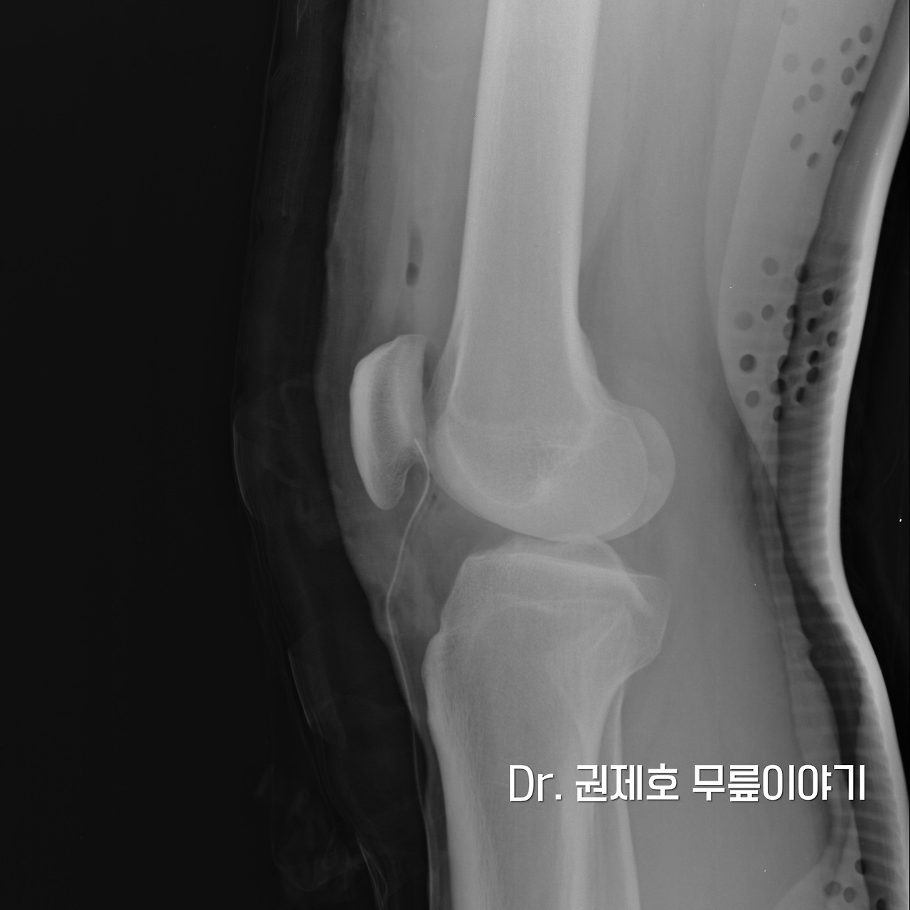 무릎연골판 방사형파열 (3).jpg