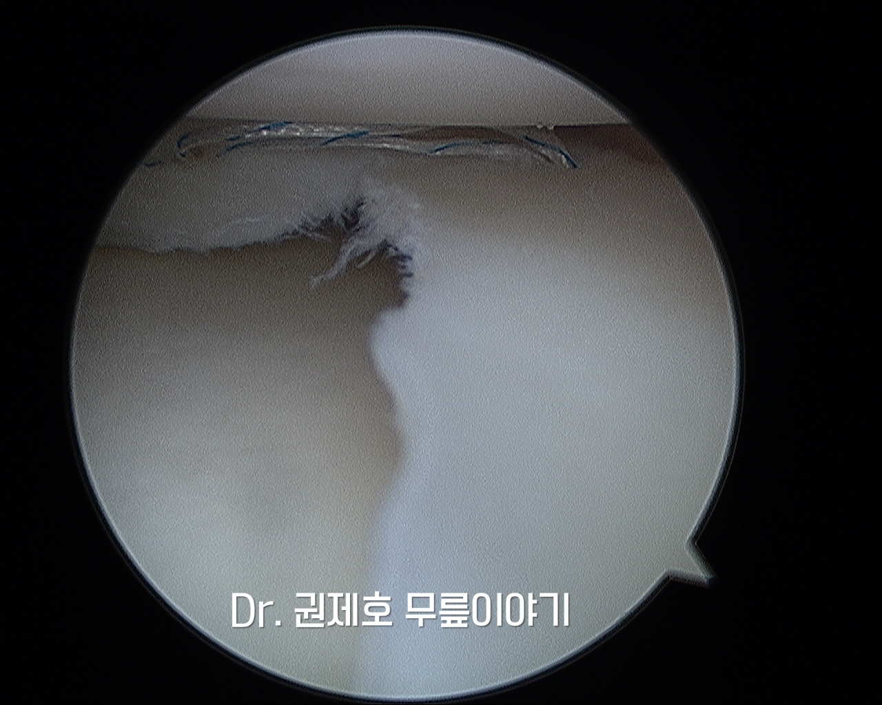 무릎연골판 방사형파열 (6).jpg