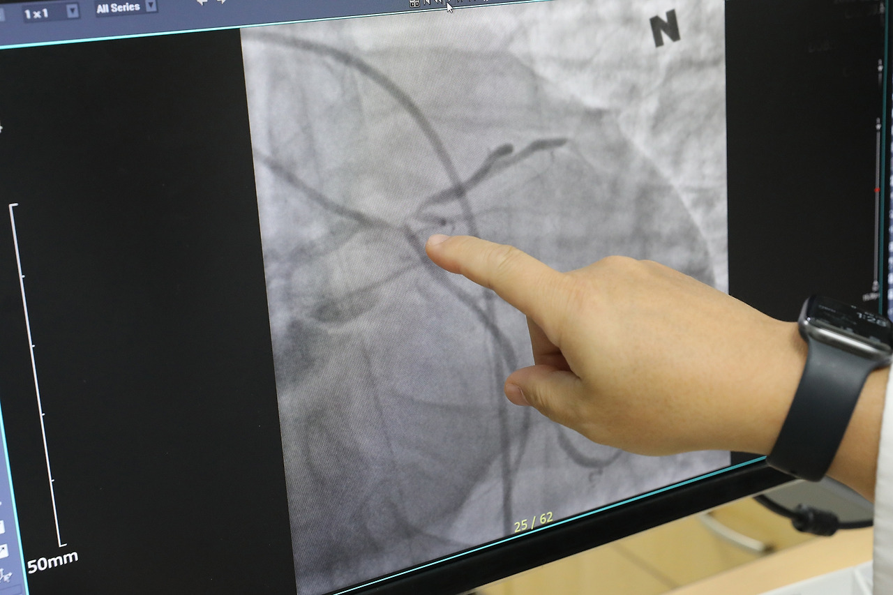 [사진] 심장혈관(관상동맥)이 막혀있는 심장마비 환자 검사 영상.jpg