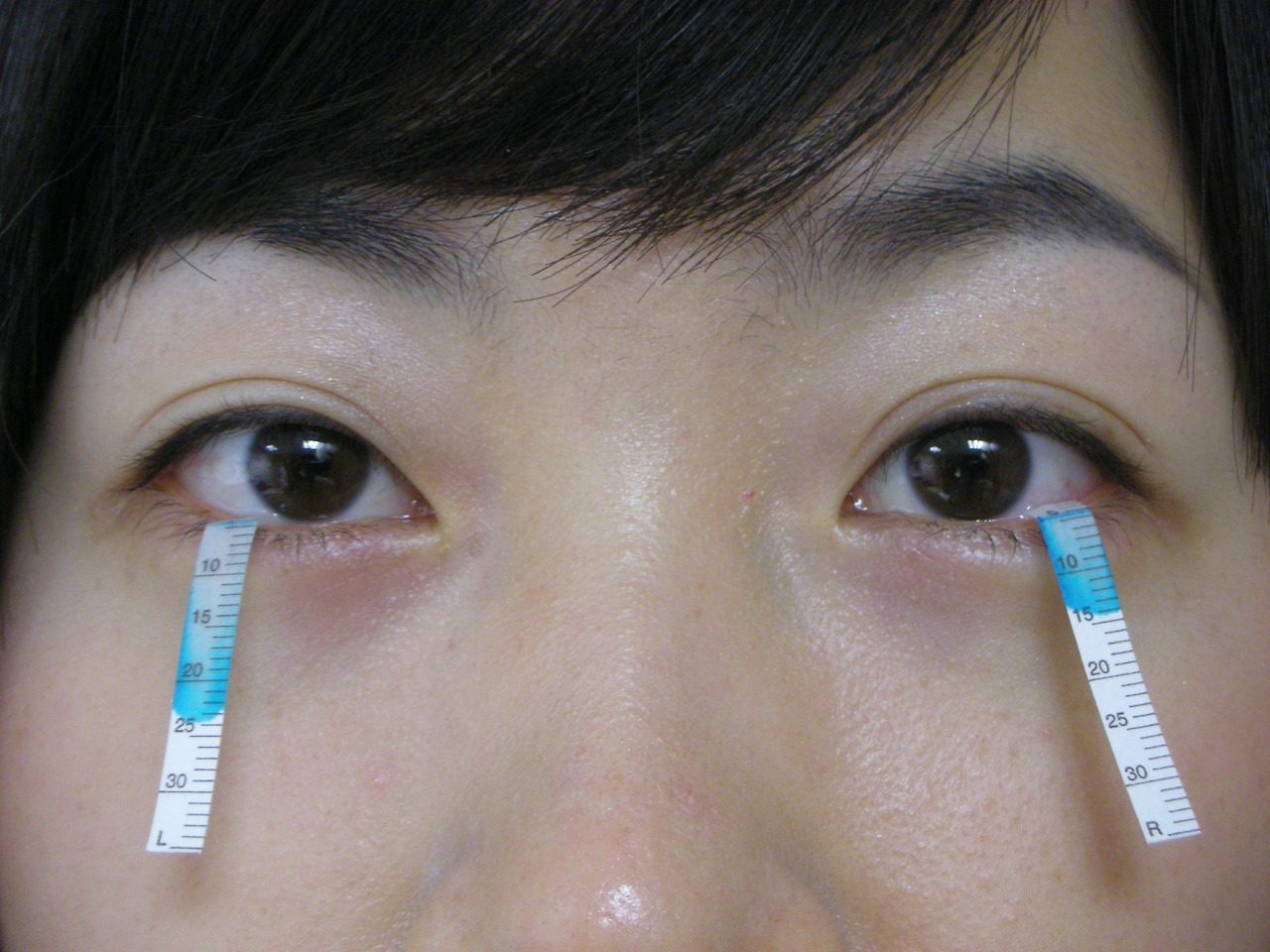 안구건조증 (7).jpg