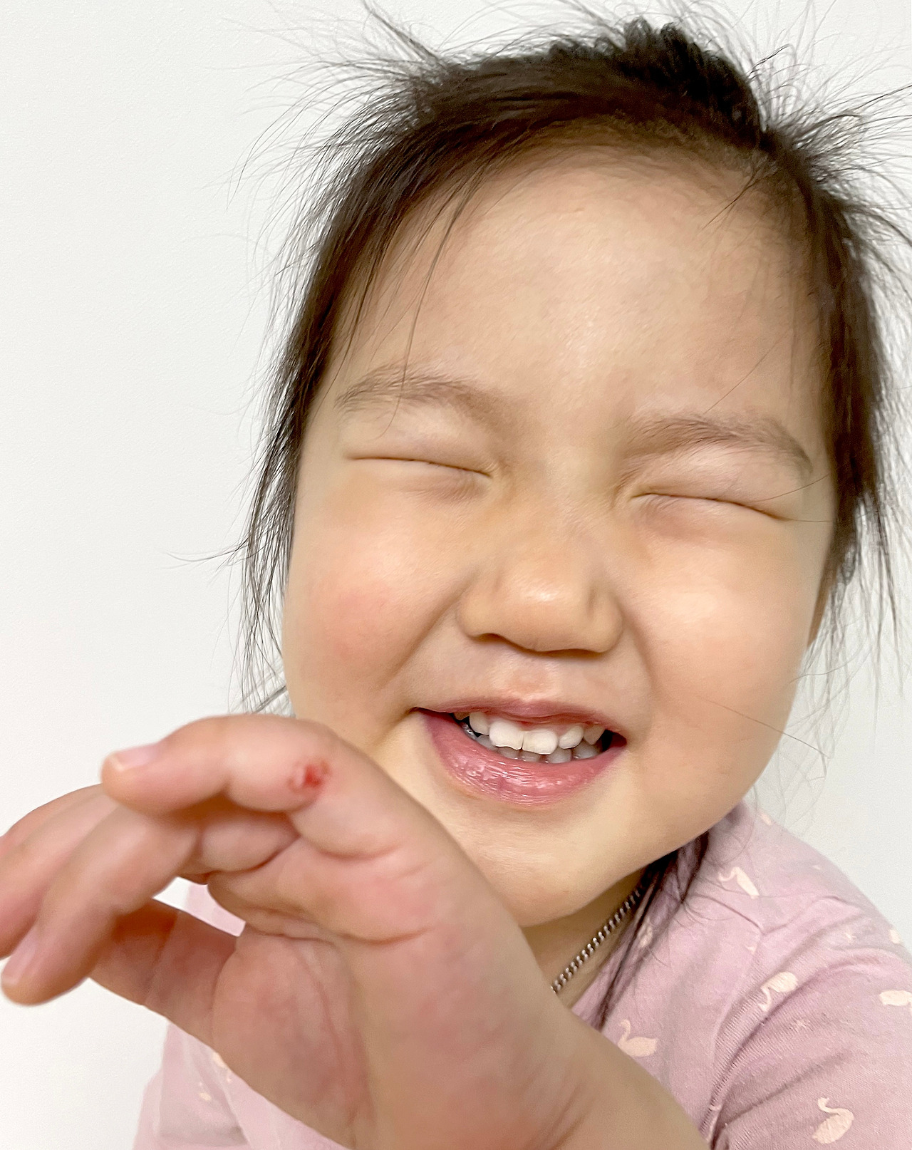 [사진]4세 아이 손 부상(찢어진 상처) 이미지_ 스스로 예방이 어려운 영·유아 주변에는 날카로운 물건은 치우고, 전기밥솥, 다리미 등은 아이 손이 닿지 않도록 높은 곳에 두어야 한다..jpg