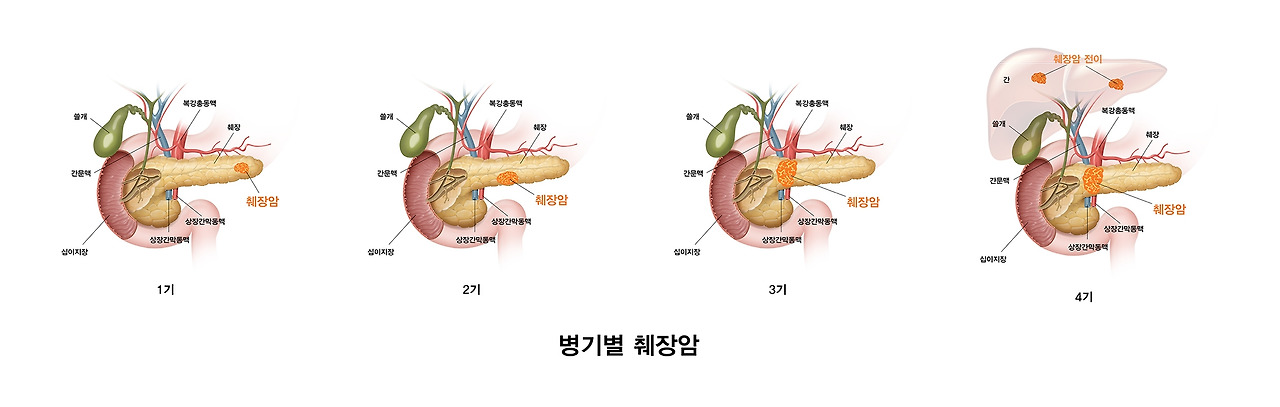 병기별 췌장암.jpg