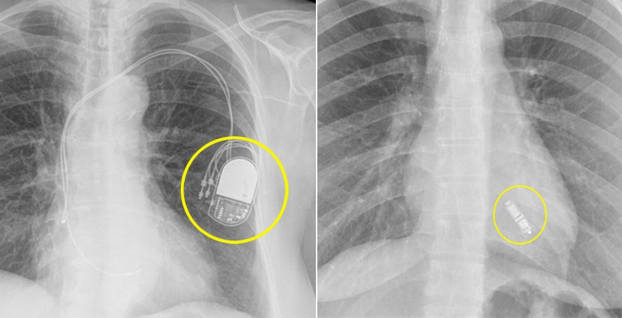 [사진]전극선 없는 무선 심장박동기는 2.6cm 정도의 캡슐 영양제 크기다. 기존 심박동기 부피의 10분의 1정도다. (좌)기존 심장박동기, (우)전극선 없는 무선 심박동기.jpg