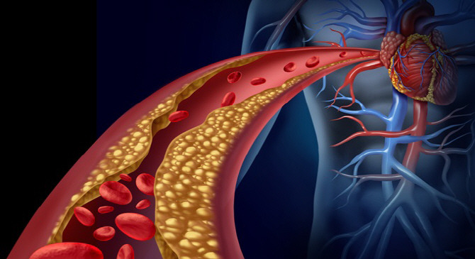 미세먼지 동맥경화.jpg