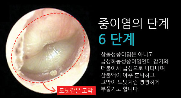 170116[칼럼-중이염3]-7.jpg