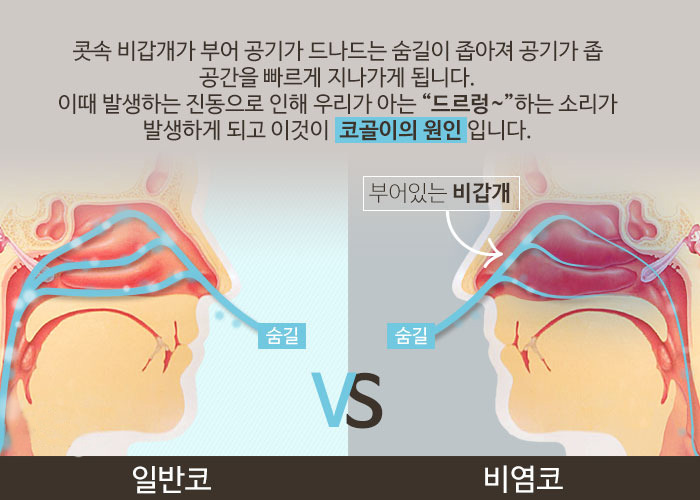 소아코골이2.jpg