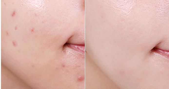 지성피부관리법+얼굴 기름기 0604.jpg