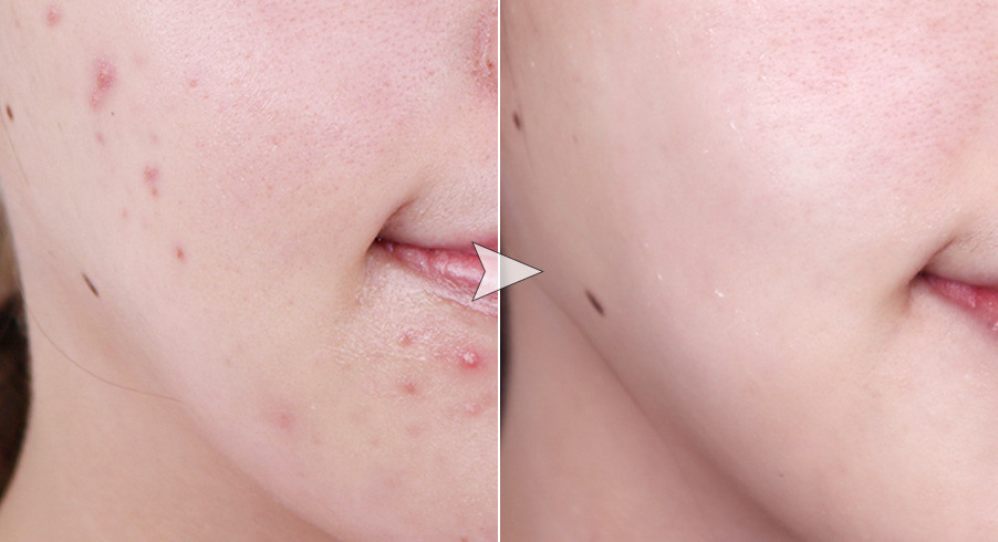 여드름 가라앉히기.jpg