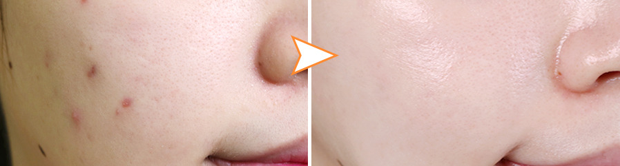 여드름 폼클렌징 추천.jpg