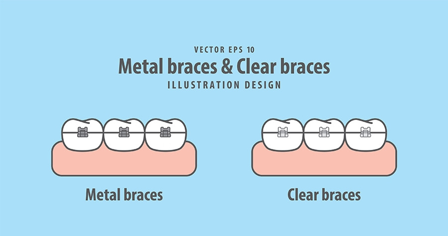 2메탈교정과 세라믹교정.jpg