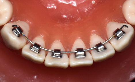 2_설측교정 (2).jpg