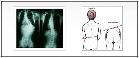 광주척추측만증 초기증상을 확인해보세요! 8