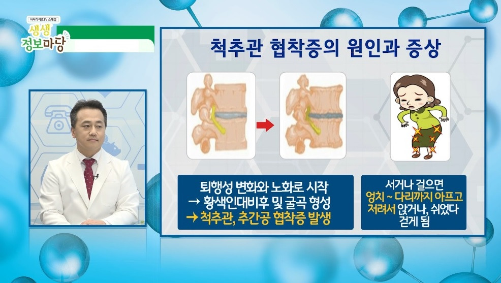 퇴행성협착.jpg