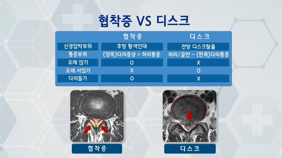 협착디스크.jpg