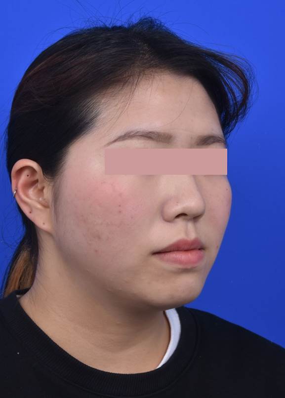 술전 우측모.jpg