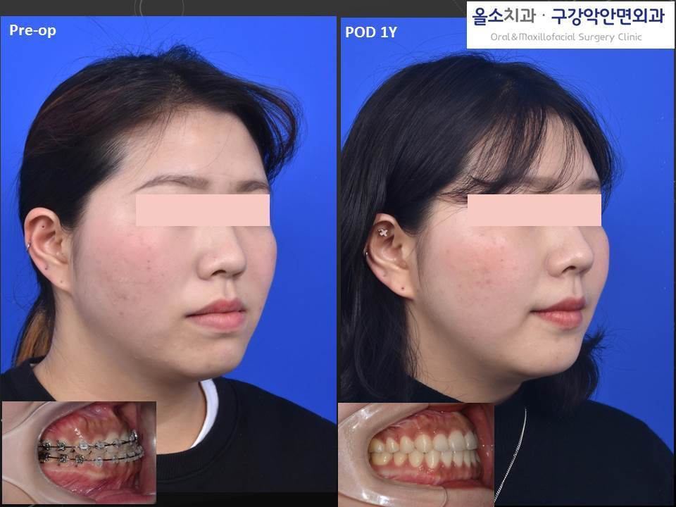 2019-4-14 서울대교정과_3D양악수술_2.jpg