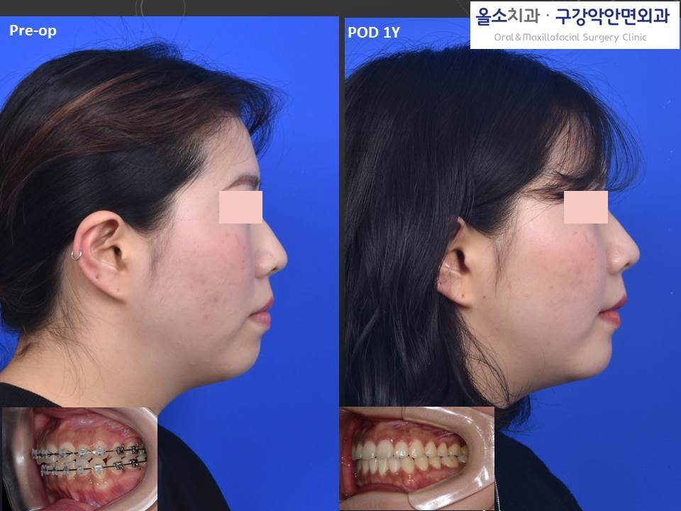 2019-4-14 서울대교정과_3D양악수술_3.jpg