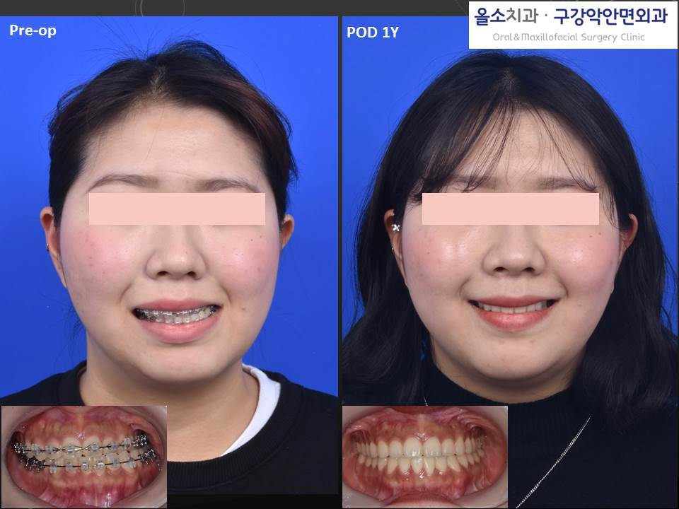 2019-4-14 서울대교정과_3D양악수술_1.jpg