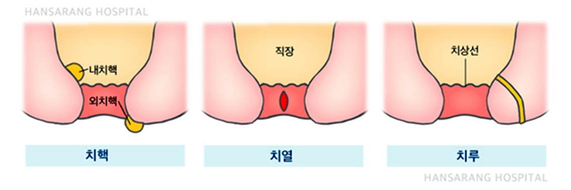 9치핵치루.jpg
