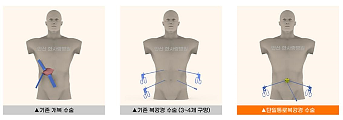 6 복강경 탈장.jpg