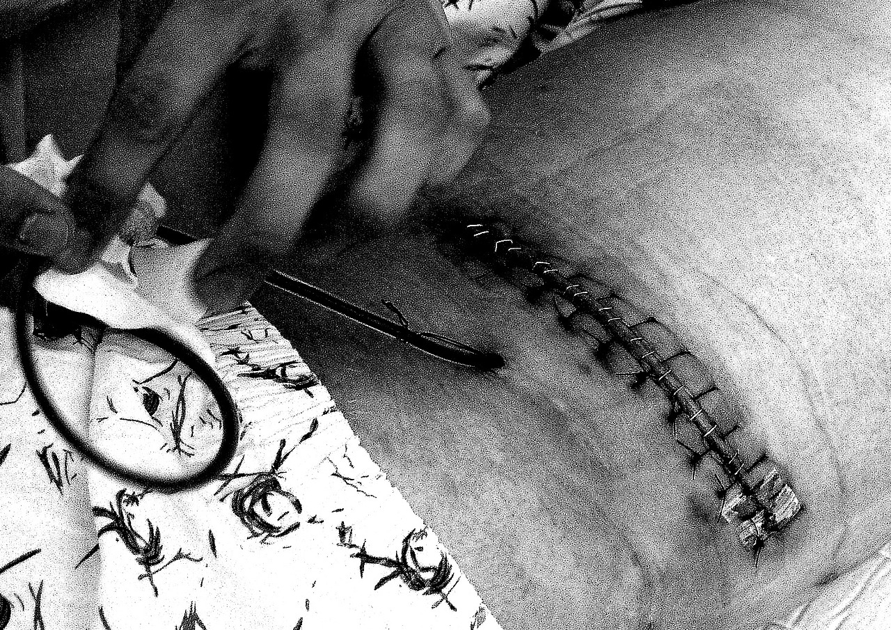 나의 왼쪽 신장 수술 - 1.jpg