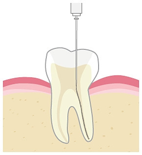 근관치료_step05.jpg