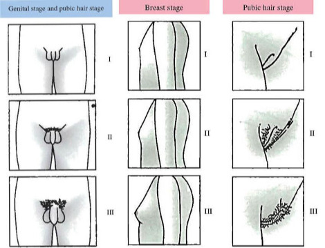 A-schematic-drawing-of-the-five-Tanner-stages-for-girls-and-boys-From-Jaruratanasirikul.jpg