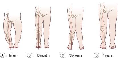 genu valgum.jpg