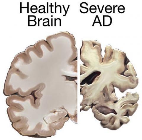 Alzheimers_brain.jpg