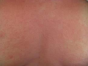 290px-Rash_on_the_chest_of_a_person_with_anaphylaxis.jpg
