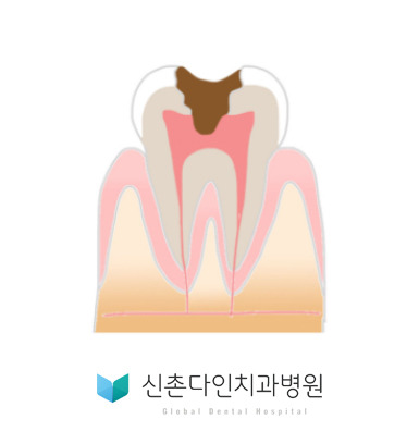 신촌다인_충치진행단계3.jpg