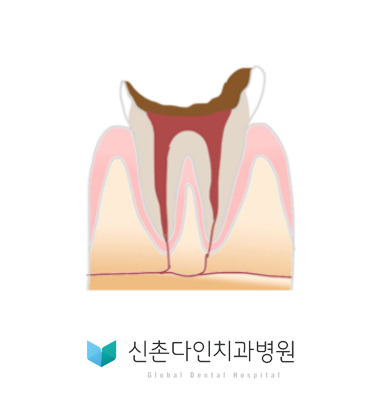 신촌다인_충치진행단계4.jpg