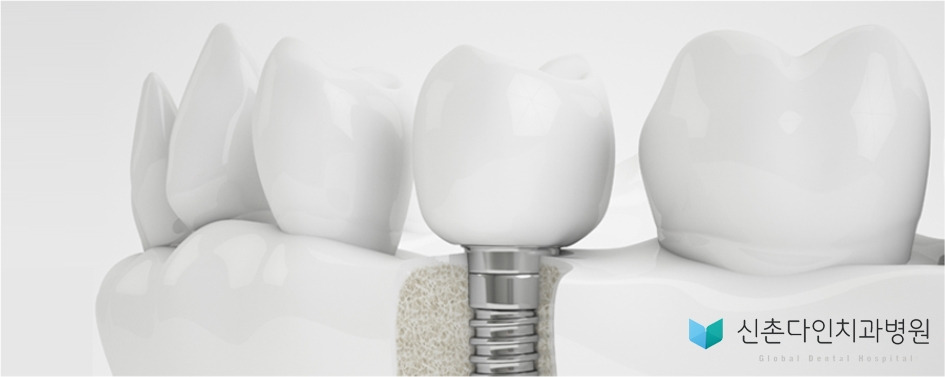 신촌역치과,신촌치과,신촌치과추천,신촌다인치과,신촌임플란트,신촌야간치과,보철.jpg
