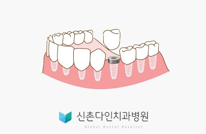 신촌다인_임플란트.jpg