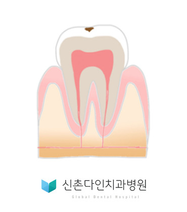 신촌다인_충치진행단계1.jpg