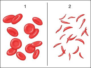 Sickle_cell_anemia.jpg