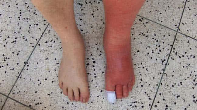 Cellulitis_Leg.jpg