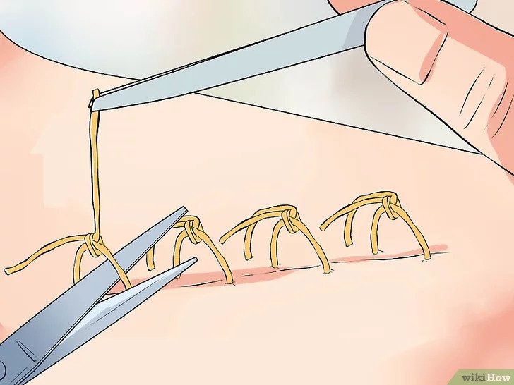 2. 봉합사 제거_위키하우.jpg