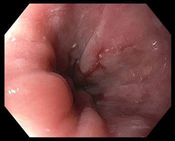 esophagitis-lynch-sized.jpg