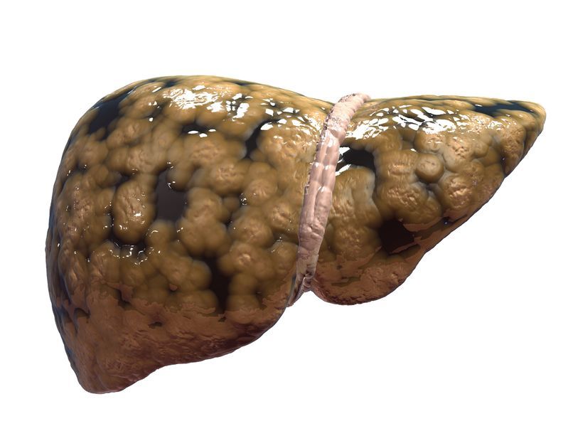 non-alcoholic-fatty-liver-disease.jpg