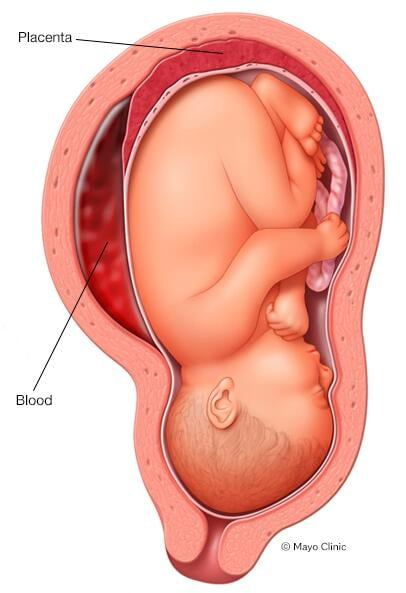 placental-abruption.jpg