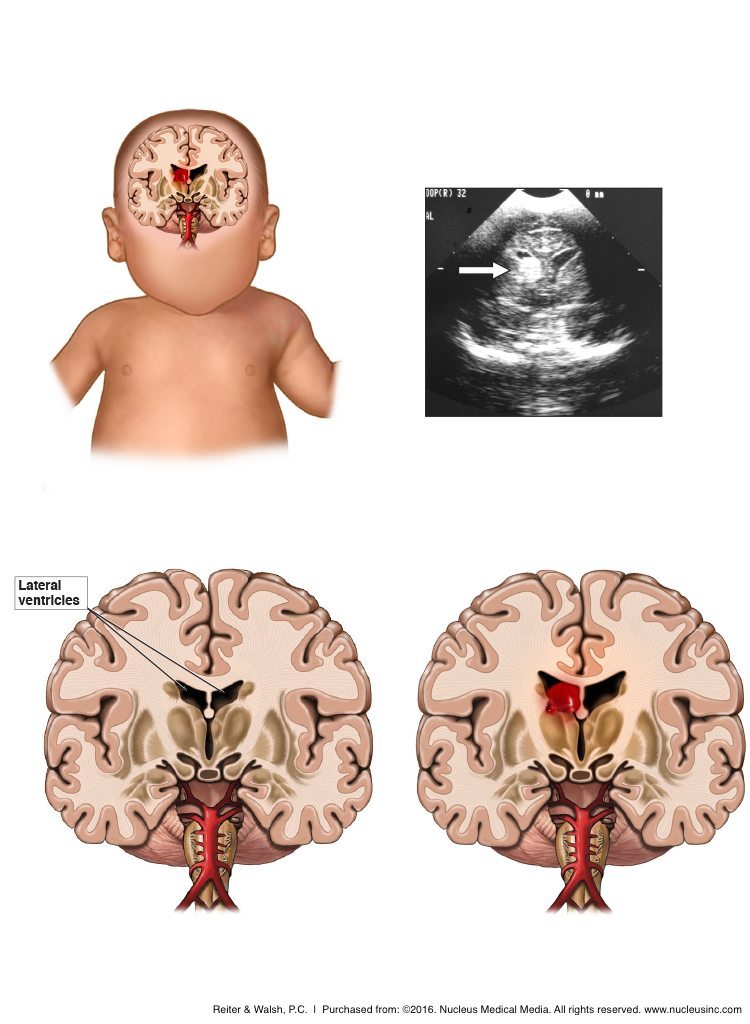 Brain-Hemorrhage-in-Infant.jpg