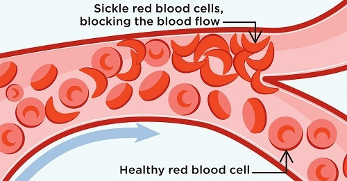Sickle-Cell-Illustration_1200x627px.jpg