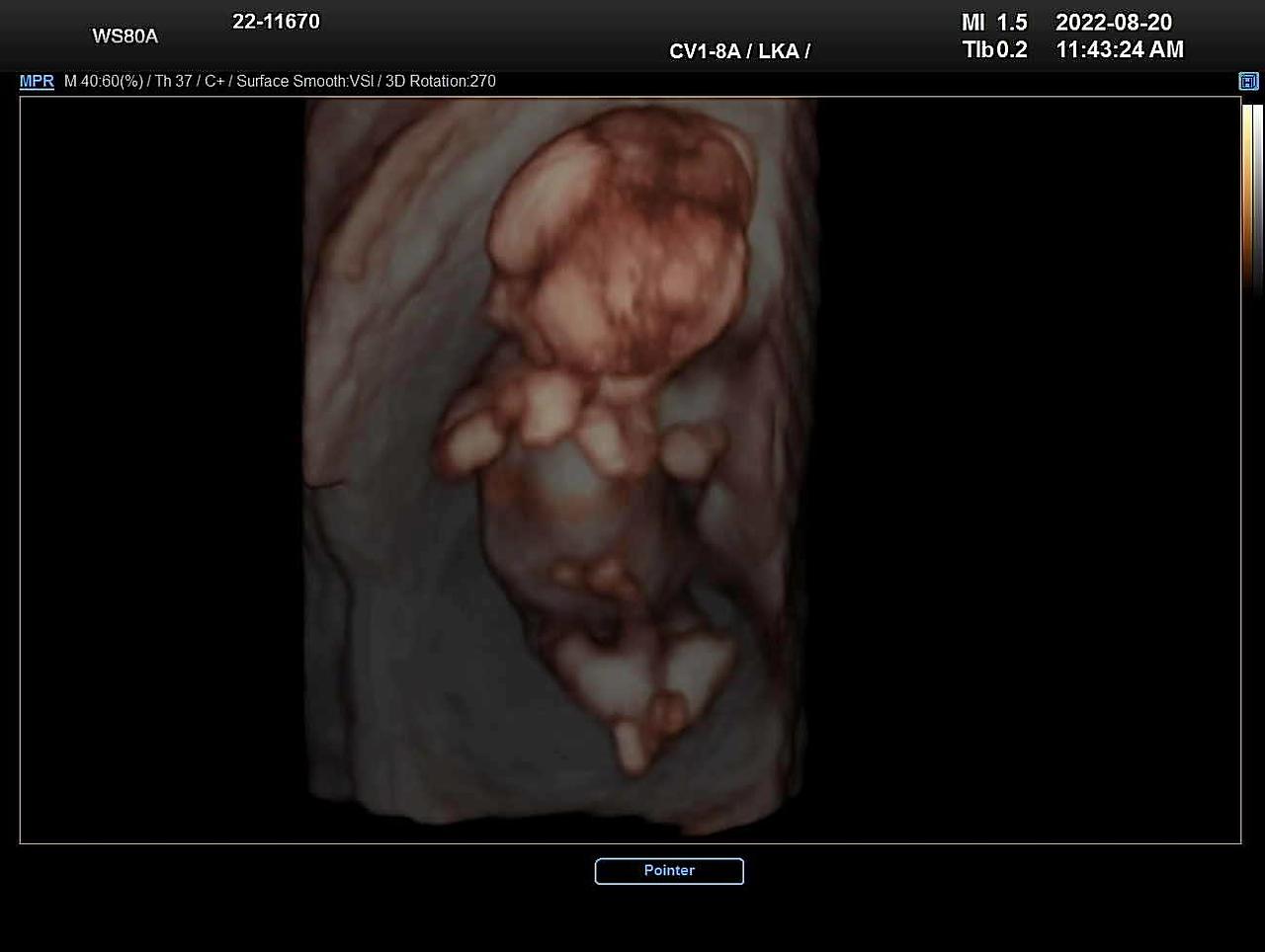 살구 입체초음파.jpg