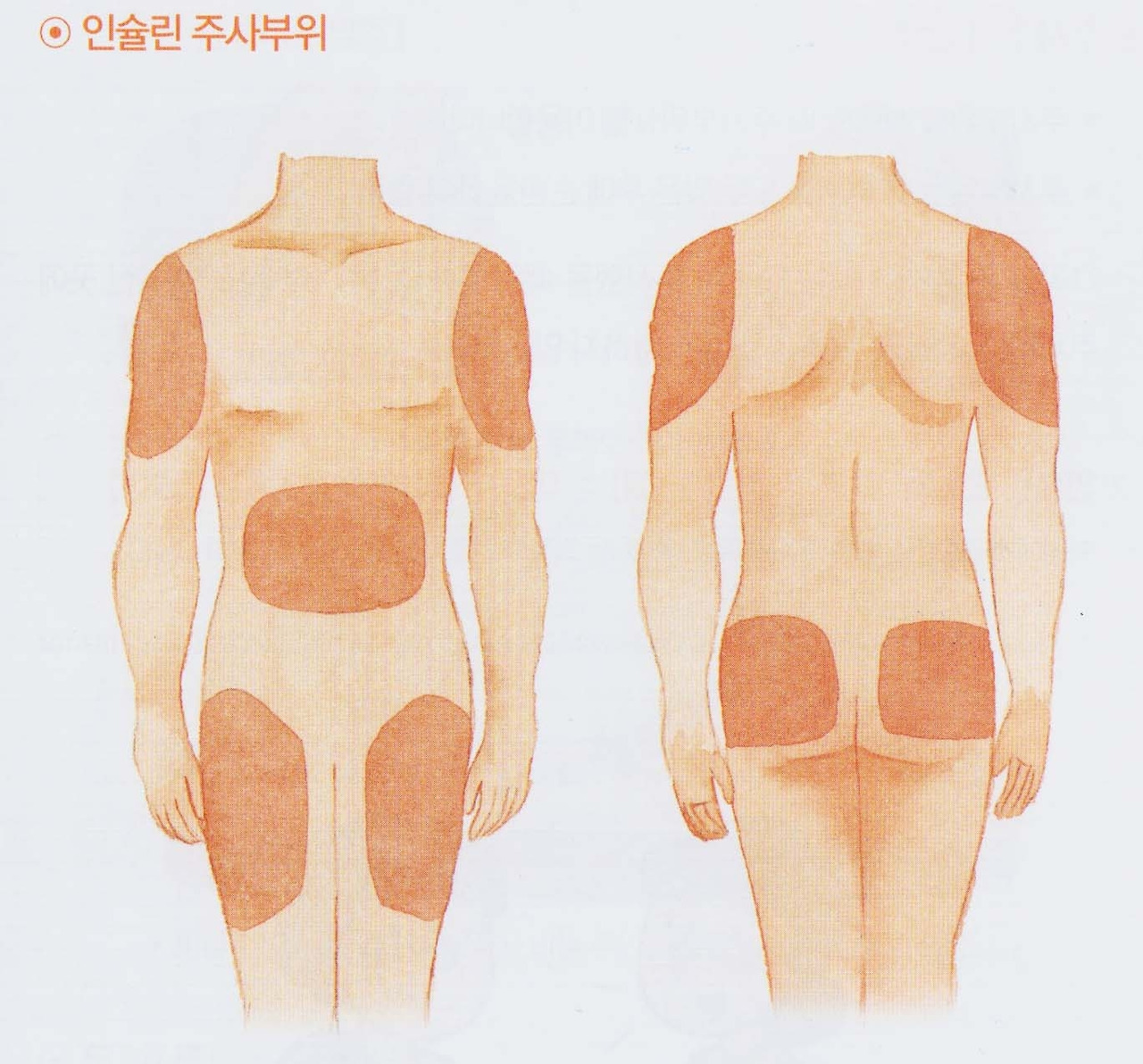 인슐린 주사부위.jpg