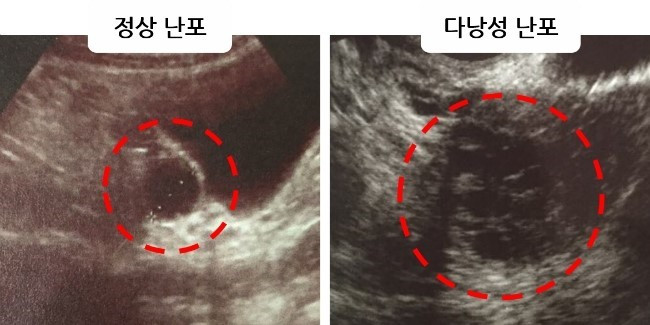 다낭성난소.jpg