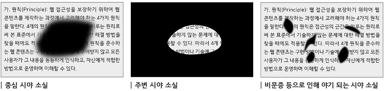 여러가지 저시력 상황에서의 시야 예시.jpg