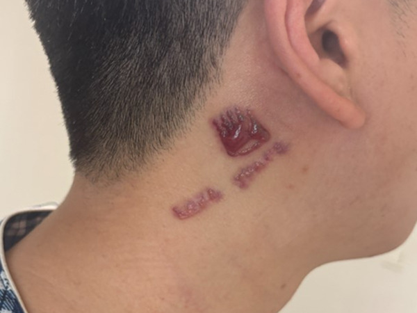 tattoo-removal procedure-IM DONG-HYUN-09.jpg