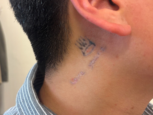 tattoo-removal procedure-IM DONG-HYUN-10.jpg