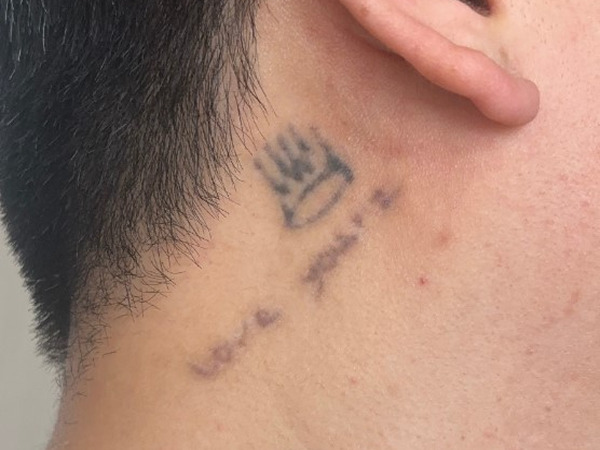 tattoo-removal procedure-IM DONG-HYUN-08.jpg